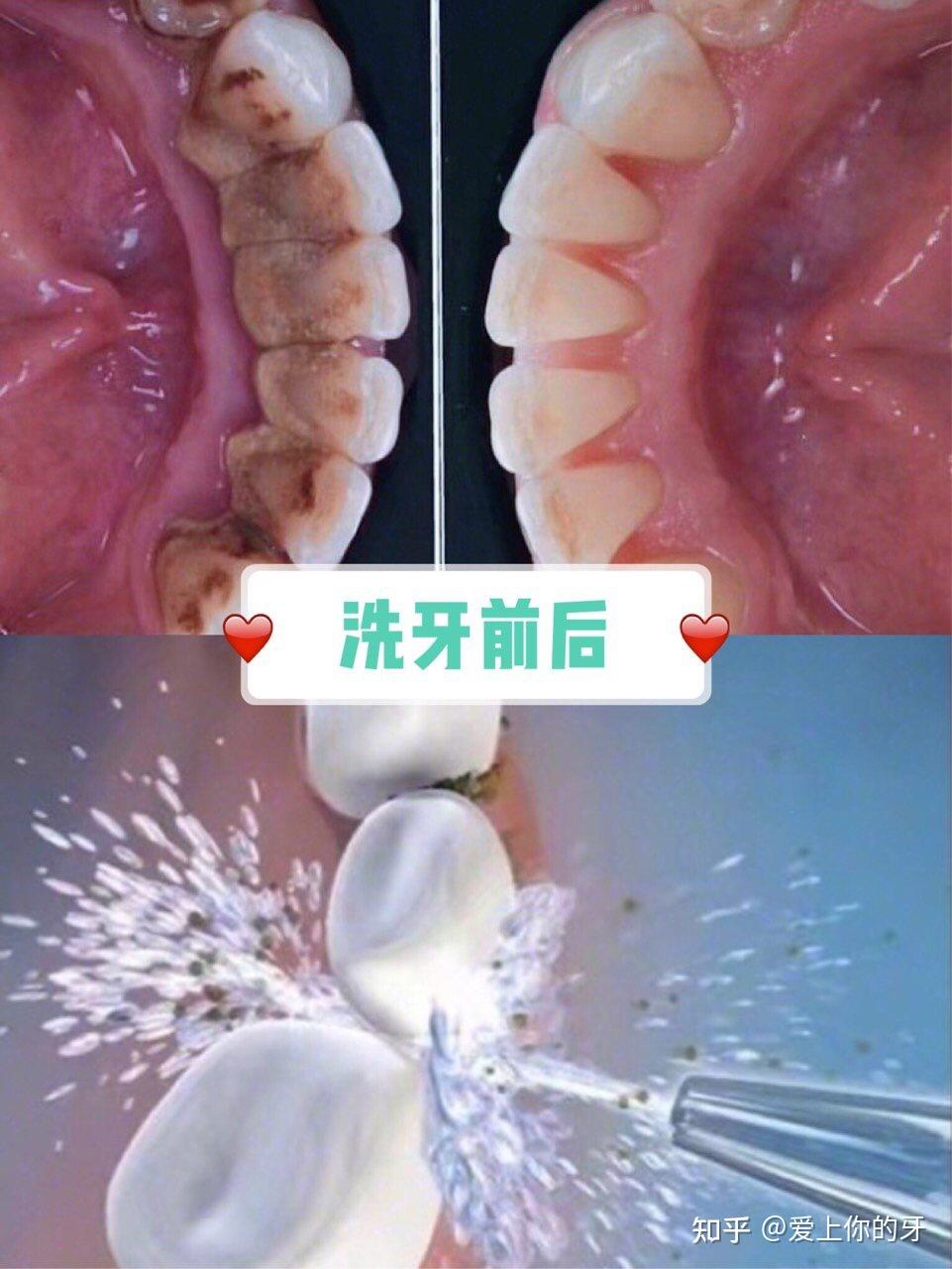 孝感洗牙可以用医保吗(洗牙可以用医保吗,报销比例多少)